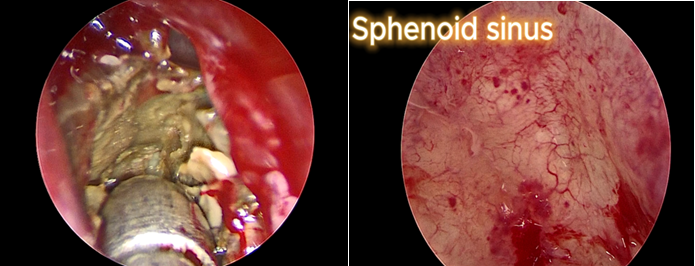 Phẫu thuật điển hình